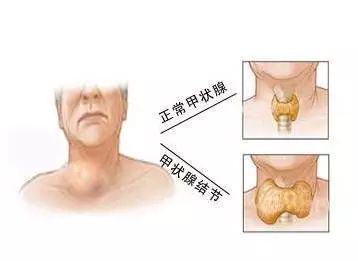 查出甲状腺结节怎么办?你想知道的全在这(建议收藏)