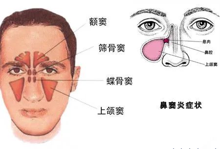 鼻窦炎和正常人的图片图片