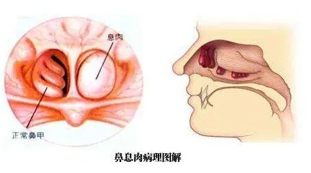 宝宝鼻子里有息肉图片图片