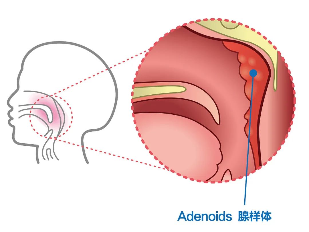 腺樣體是鼻腔鼻咽頂部位置的軟組織,扁桃體是我們口腔