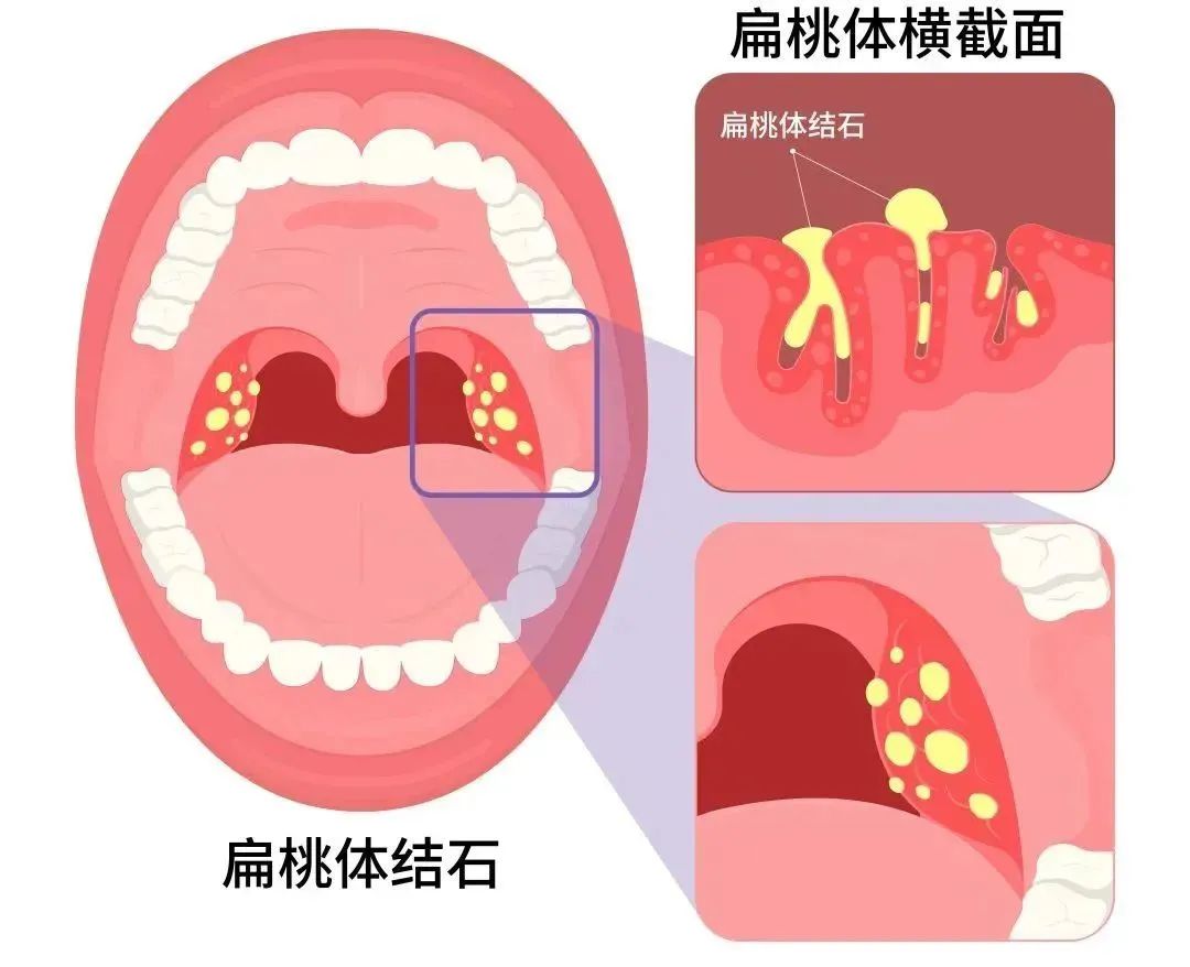 5岁儿童扁桃体角化症图片